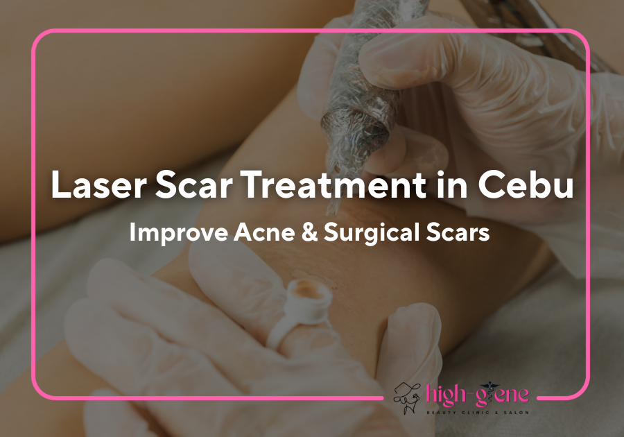 Laser Scar Treatment in Cebu: Improve Acne & Surgical Scars 