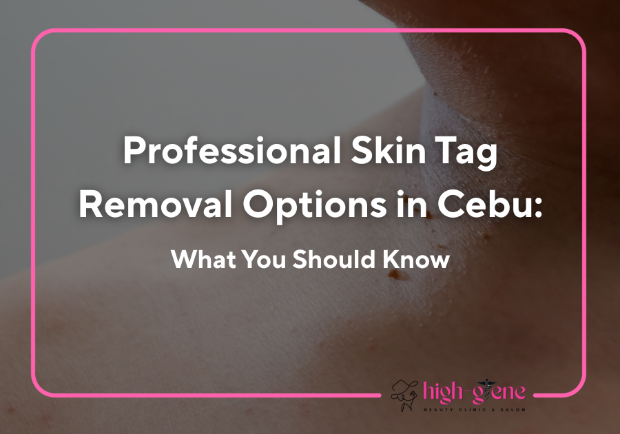 Professional Skin Tag Removal Options in Cebu: What You Should Know